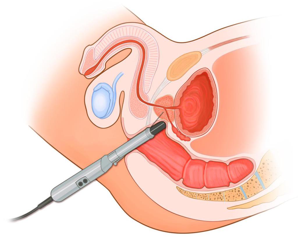 УЗИ предстательной железы трансректально