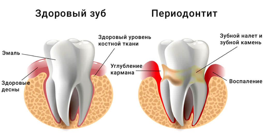 Лечение периодонтита  (2-корневого зуба)