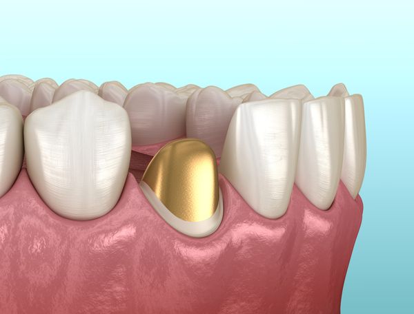 Восстановление разрушенной коронки путем металлической вкладки